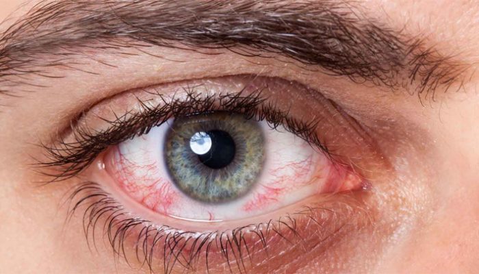 Mata Sering Kabur? 5 Gangguan Mata yang Bisa Menjadi Pertanda Diabetes