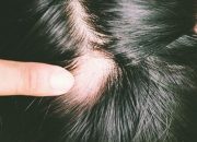 Solusi Ampuh Atasi Rambut Pitak Tanpa Ribet