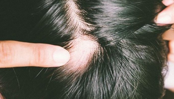 Solusi Ampuh Atasi Rambut Pitak Tanpa Ribet
